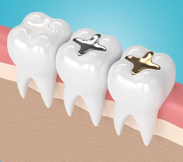 Conway Composite Fillings