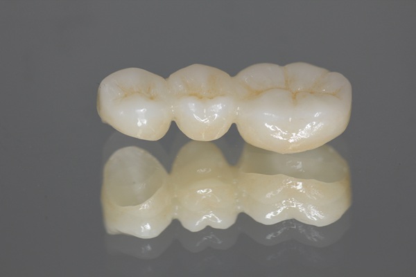 Dental Bridge Options: How Bridges Replace Missing Teeth And Support Bite Function