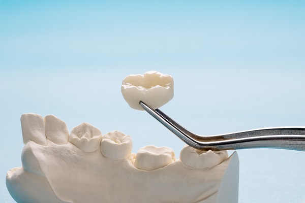 The FAQ&#    ;s Of Gold Dental Crowns