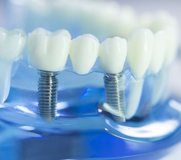 Conway Dental Implants