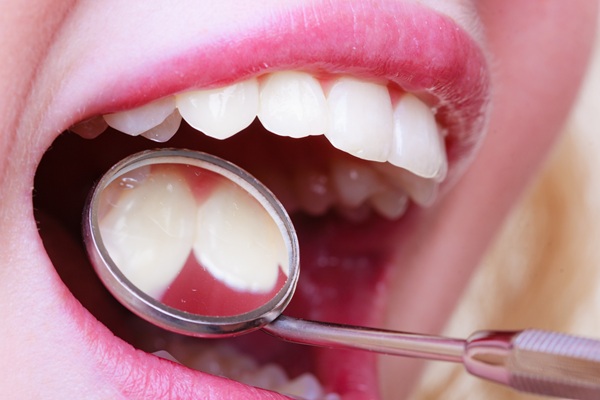 When Might A General Dentist Recommend A Dental Filling?