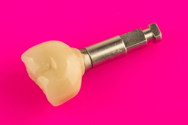 How Long Does An Implant Crown Restoration Last?